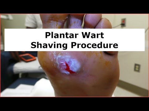download lagu mp3 mp4 How Does Salicylic Acid Work On Warts, download lagu How Does Salicylic Acid Work On Warts gratis, unduh video klip How Does Salicylic Acid Work On Warts