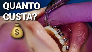 QUANTO CUSTA pra botar APARELHO ORTODÔNTICO [Direto ao Ponto]
