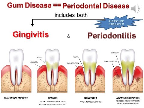Gingivitis & Periodontitis 22MarApr22