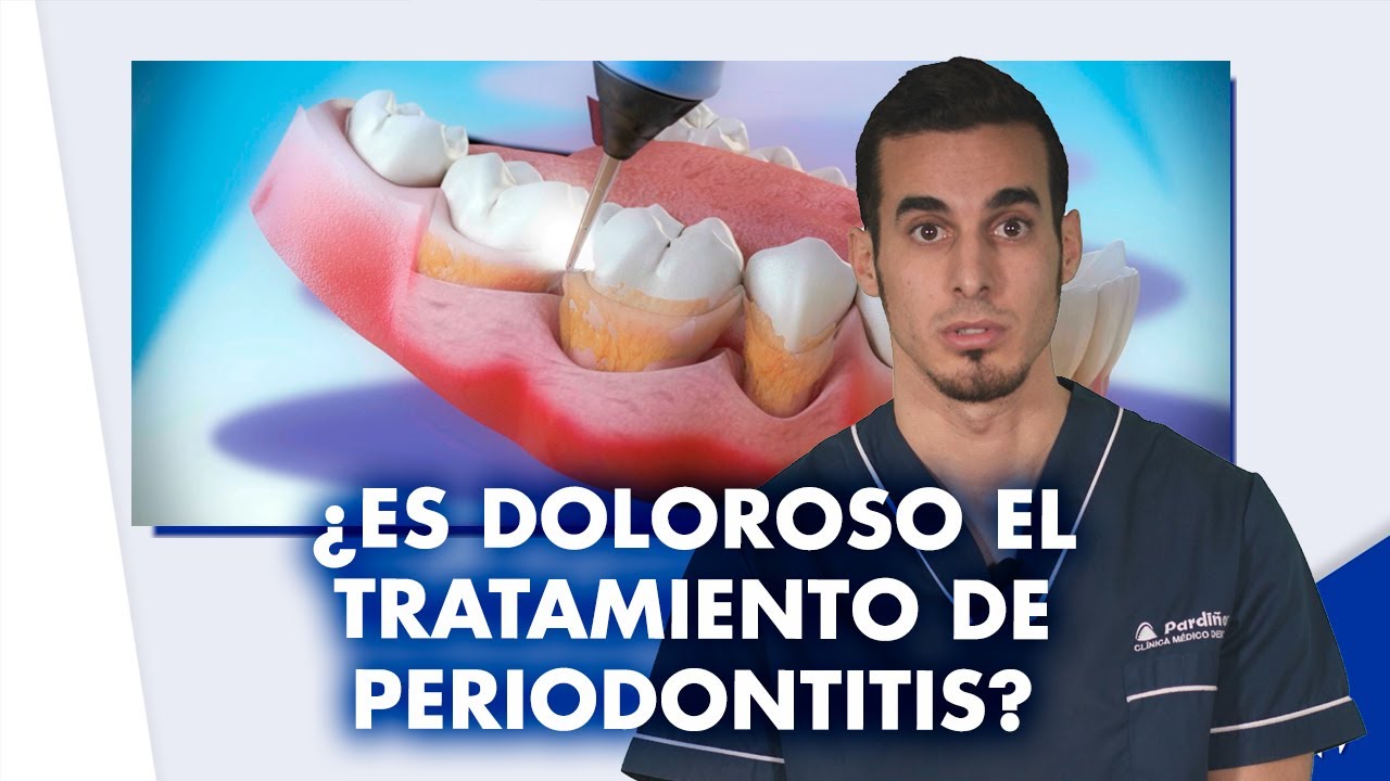 Tratamiento de la PERIODONTITIS - ¿Es doloroso ¿Cuánto vale | #Shorts