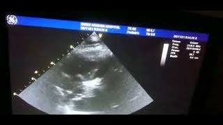 VIDEO COMMENTARY OF POST - OPERATIVE ICR