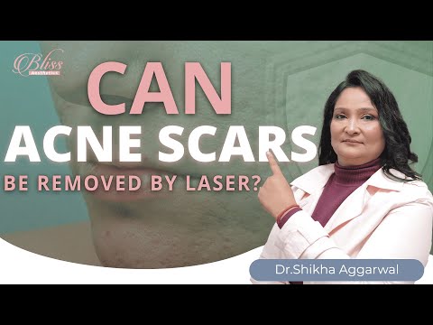 Acne & Scar Laser Treatment