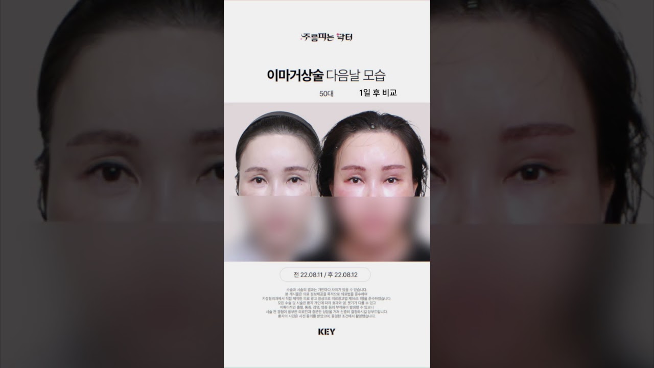 50대 이마거상술 다음날 모습 / 대구 이마거상 대구키성형외과
