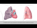 Lung Transplant Animation