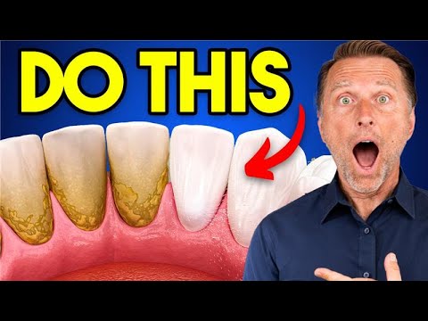 The #1 BEST Remedy for Dental Plaque (TARTAR)