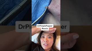 I&#39;m not sure what she&#39;s doing! Dr Pimple Popper Reacts to Cyst Removal