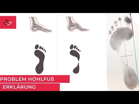 Hohlfuß - Unterschätzt und oft unerkannt