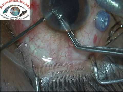 Pars Plana Vitrectomy and Removal of Intraocular Foreign Body