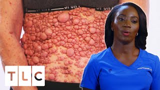 Doctor Treats One Of The Most Extensive Cases Of Neurofibromatosis She’s Ever Seen | Dr. Mercy