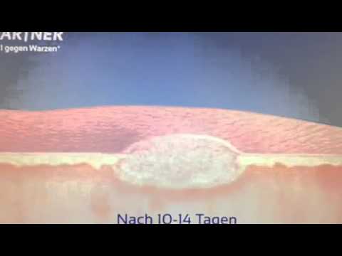 Wartner® TVC 2013 (Umgekehrt)