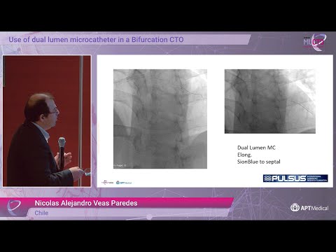 Use of Dual Lumen Microcatheter in a Bifurcation - Dr. Nicolas Veas