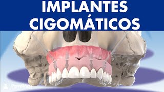 Implantes CIGOMÁTICOS - Cómo colocar implantes a pacientes con poco hueso © - Clínica Dental Pardiñas