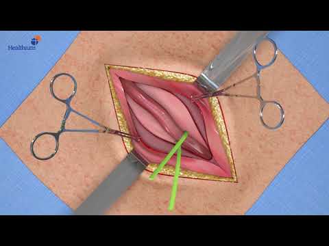 Healthium Non Absorbable Polypropylene Surgical Mesh