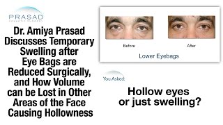 Why Swelling after Eye Bag Surgery Can Temporarily Affect Appearance, & Treating Adjacent Hollowness
