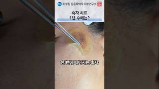 흑자 치료의 경과와 재발 관리