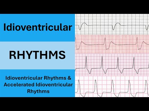 EKG Basics Explained:  Idioventricular Rhythms