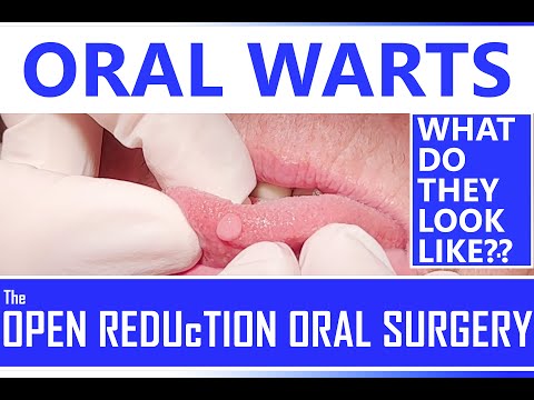 What Do Oral Warts Look Like? How To Identify A Mouth Wart | HPV Papilloma