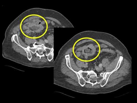 CT Evaluation of Small Bowel Obstruction Part 3