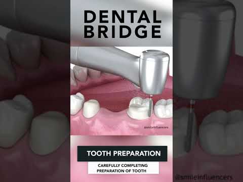 Dental Bridge #shorts