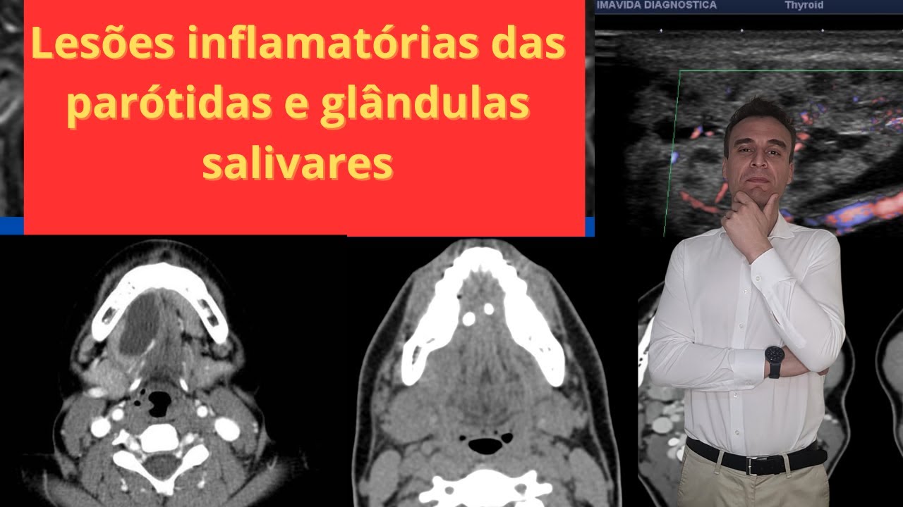 Parótida onde fica? Parótida inchada é caxumba ou parotidite? Como a radiologia pode ajudar