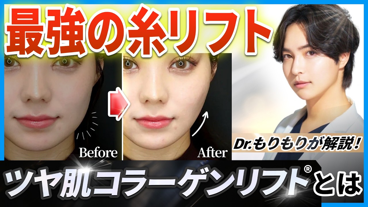 ツヤ肌コラーゲンリフトって？【美容ドクターもりもり】