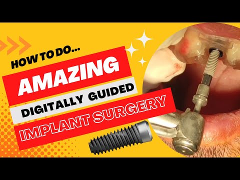 Guided Implant Surgery | Flapless And Fresh Socket Implant Insertion With Surgical Guide