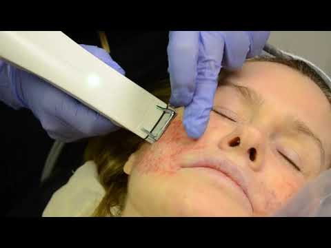 Skin Tightening with A Profound RF Treatment