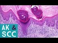 Squamous Cell Carcinoma Actinic Keratosis 101 Dermpath Basics Beyond