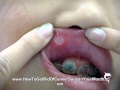 How To Get Rid Of Canker Sores In Your Mouth ...