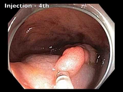 Flat Lesion in Cecum - EMR