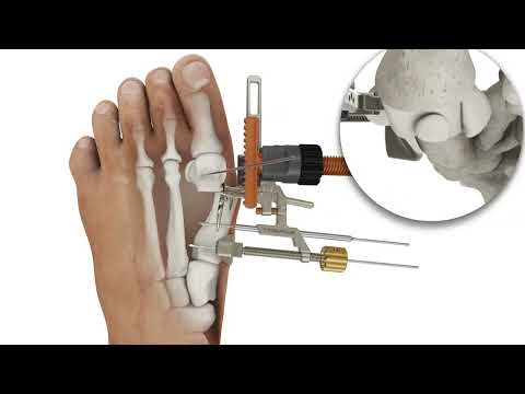 Nanoplasty™ 3D Bunion Correction® System