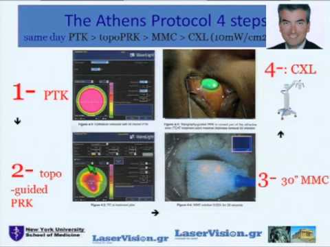 Hiperópia videó. Hogyan kezeljük a hyperopia-t?