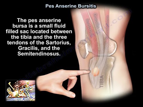 Pes anserinus Syndrom