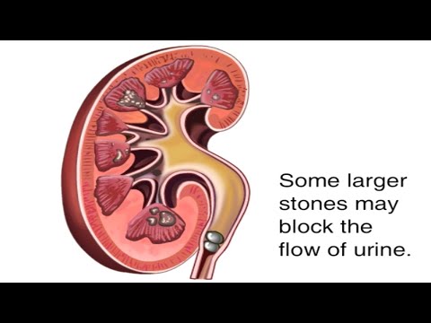, title : 'How Kidney Stones Are Formed Animation - Renal Calculi Causes & Symptoms Video - Blocked Urine Flow'