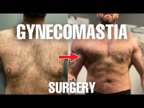 Gynecomastia Surgery changed my LIFE