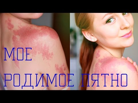 Пигментация кожи на ногах от вен Clinique пигментных пятен отзывы