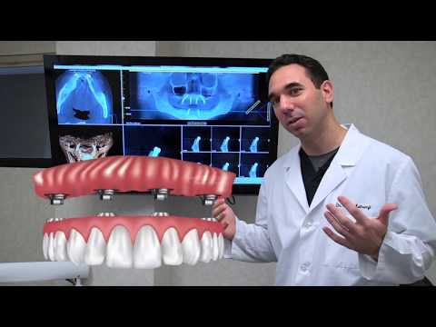 All on 4 Dental Implants Explained