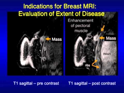 UCSF Radiology: Mammography Images Revealing What Cancer Looks Like