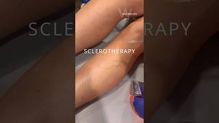 Permanently remove leg veins commonly known as spider veins with Sclerotherapy!