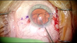 Download Lagu Exchange and Haptic Fixation (Yamane Technique) of RxSight Light Adjustable Lens Thumbnail