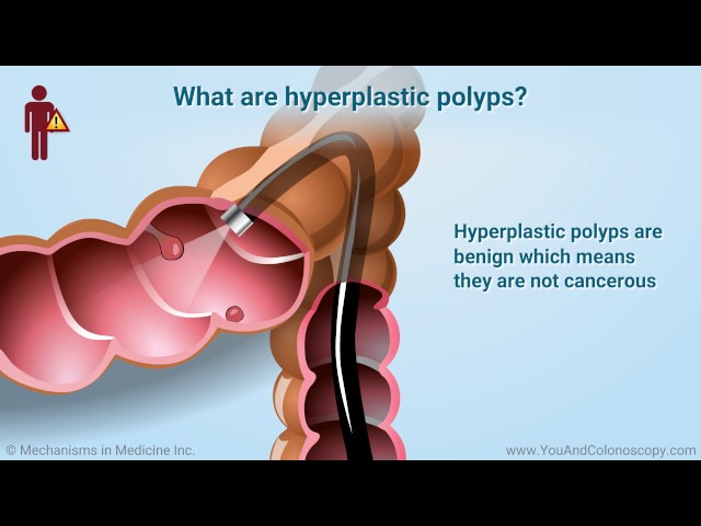 Video Pronunciation of hyperplastic polyp in English Video Pronunciation of hyperplastic polyp in English