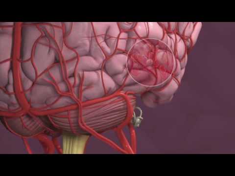 Migraines and Vertigo - Mayo Clinic