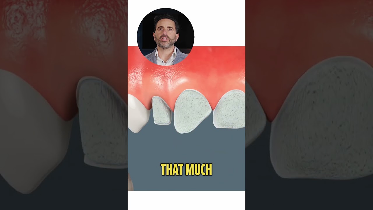 The TRUTH About Veneers (Dentist REVEALS All)