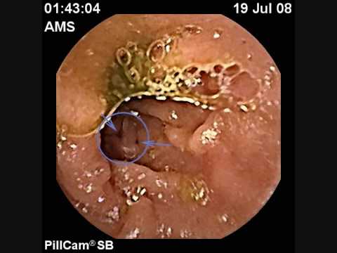 Endoscopy Of Gastrointestinal Tract By Usage Of The  Capsule