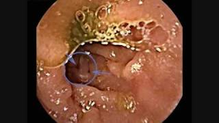 preview picture of video 'CAPSULE ENDOSCOPY'
