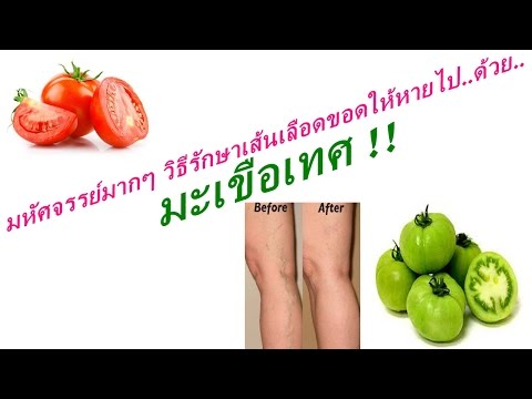 Kartalin กลาก Oufb-04 คำแนะนำหวานใจสำหรับการใช้งานในตารางโรคสะเก็ดเงิน