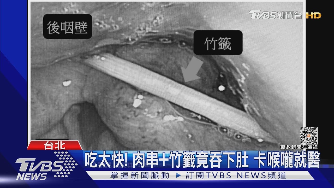 吃太快!肉串+竹籤竟吞下肚 卡喉嚨就醫