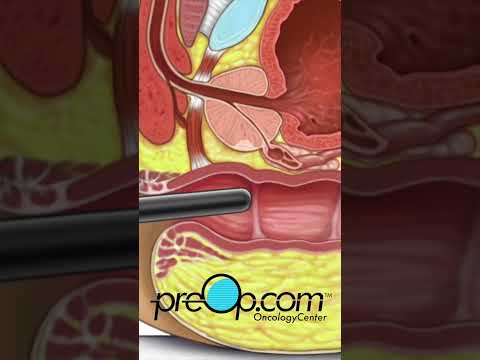 🔍 PreOp® Transrectal Ultrasound And Prostate Biopsy Patient Ed 💡Master Key Steps Quickly✨ #shorts
