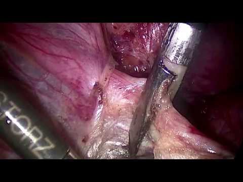 marSeal5 – Anwendungen in der GYN (Teil 3)