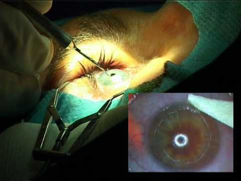 clinică pentru corecția vederii cu laser Tikhov viziunea în sine este restabilită